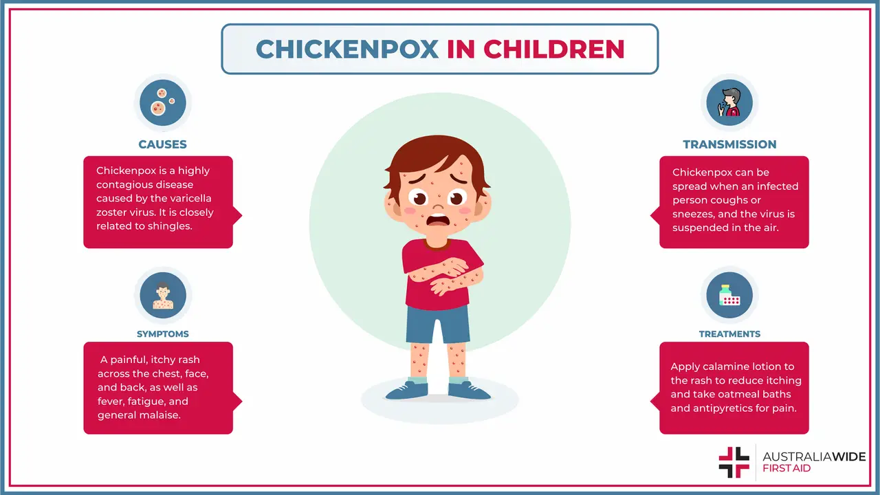 Infographic on Chickenpox in Children