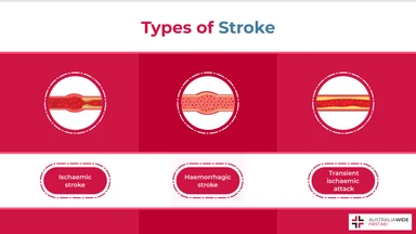 Infographic Showing Three Different Types of Stroke